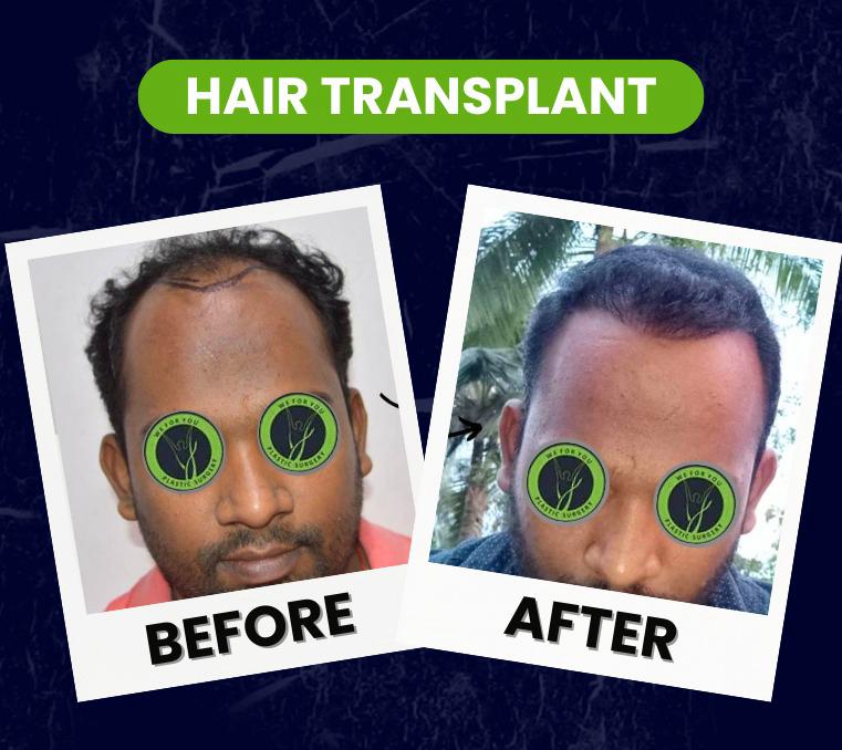 hair transplant surgery